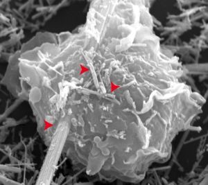 Ученые разгадали как нити асбеста (показаны красными стрелками; на рисунке они улавливаются белыми клетками крови) инициируют травмы легких и рак (использовано изображение http://sciencenow.sciencemag.org). (кликните картинку для увеличения)