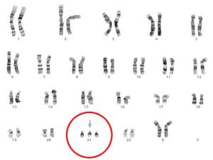 Патологии хромосом. (кликните картинку для увеличения)