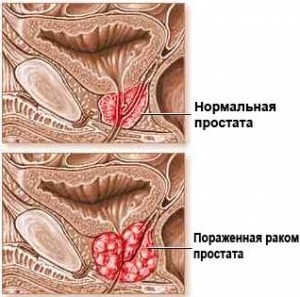 Нормальная и пораженая раком предстательная железа (с сайта http://uromax.ru/) (кликните картинку для увеличения)