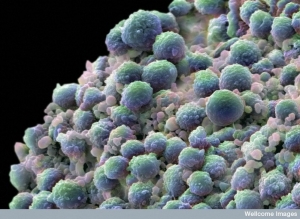 Рак предстательной железы (http://images.wellcome.ac.uk/) (кликните картинку для увеличения)
