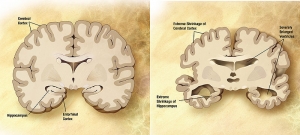 Мозг пожилого человека в норме (слева) и при патологии, вызванной болезнью Альцгеймера (справа), с указанием отличий. (wikipedia) (кликните картинку для увеличения)