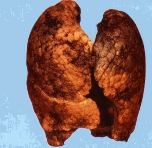 Морфология лёгких курильщиков (http://cl.us-in.net) (кликните картинку для увеличения)