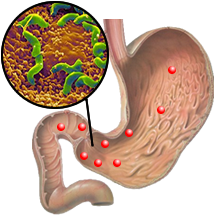 Колония Хеликобактер пилори (<i>Helicobacter pylori</i>) на слизистой оболочке желудка (http://www.helicobacter.ru/)