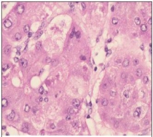 Гепатоцеллюлярная карцинома трабекулярного типа у больного вирусным (гепатит В) циррозом печени (http://www.rmj.ru/)
  (кликните картинку для увеличения)