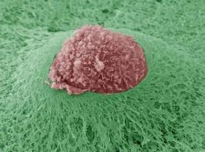 Раковая клетка (метастазирование) (Источник: http://www.st-cells.com/)
 