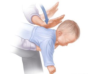 Если у вас возникли подозрения, что ребенок вдохнул инородное тело: 
1)Пальцем проверьте рот ребенка и извлеките оттуда инородные тела (остатки пищи, игрушки) 
2)Немедленно положите ребенка себе на колени лицом вниз и совершите несколько ритмичных, толчкообразных ударов основанием ладони по области между лопаток. Удар должен быть скользящим (снизу вверх: из межлопаточной области в сторону головы). 
3)Позовите на помощь и вызовите скорую помощь. (кликните картинку для увеличения)