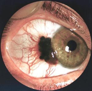 Меланома конъюнктивы: видна темно-коричневая проминирующая опухоль с неровными краями и выраженной перифокальной инъекцией сосудов, распространяющаяся на область лимба. (кликните картинку для увеличения)