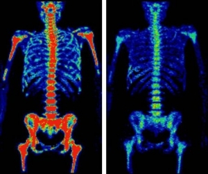 Снимок скелета человека, полученный с помощью позитронно-эмиссионной томографии. (кликните картинку для увеличения)