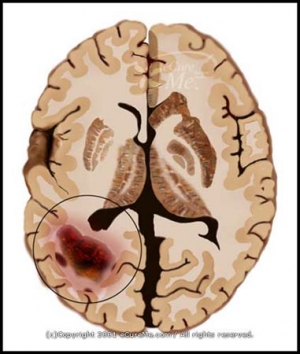 Пример расположения опухоли в головном мозге. (кликните картинку для увеличения)