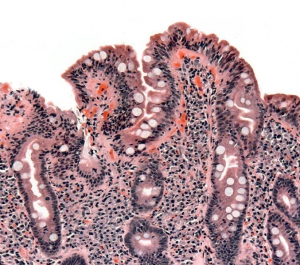 Биопсия тонкого книшечника у больного целиакией. Видна уплощенная форма ворсинок, лейкоцитарная инфильтрация и гиперплазия крипт. (кликните картинку для увеличения)