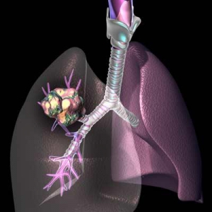 Иллюстрация, которая поясняет, в каких местах может начаться перерождение тканей лёгкого. (кликните картинку для увеличения)