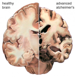 На рисунке представлено изображение среза мозга здорового человека (слева) и среза мозга человека, у которого обнаружена болезнь Альцгеймера, протекающая на поздних стадиях своего развития (справа). (кликните картинку для увеличения)
