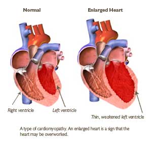 В левой части рисунка показано здоровое сердце, в правой – увеличенное.