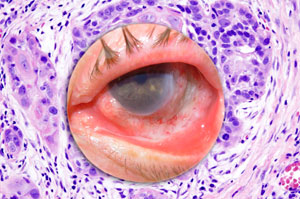 Исследование клеток роговицы глаза, ученые могут предупредить рецидив рака роговицы