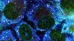 Фотография клеток злокачественной опухоли простаты. (кликните картинку для увеличения)