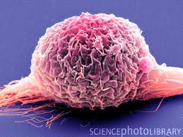 Изображение клетки опухоли мочевого пузыря.