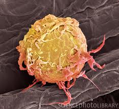 Клетка опухоли лимфатической ткани.