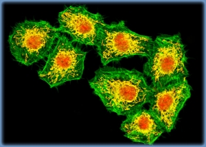 Клетки опухоли головного мозга (глиомы) человека. (кликните картинку для увеличения)