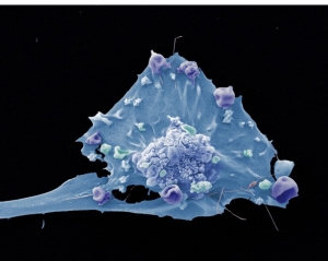 Снимок клетки опухоли молочной железы. (кликните картинку для увеличения)