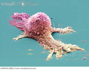 Клетка раковой опухоли яичника. (кликните картинку для увеличения)