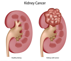Схематическое изображение раковой опухоли почки. Слева – здоровая почка, справа – поражённая раком.