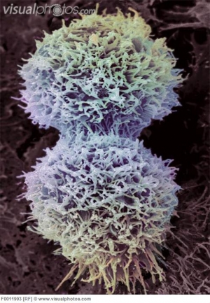 Клетки раковой опухоли шейки матки. (кликните картинку для увеличения)