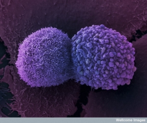 Клетки раковой опухоли лёгких. (кликните картинку для увеличения)