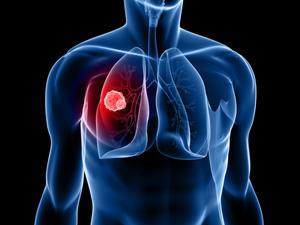Рак лёгкого — одна из основных причин онкологической летальности у мужчин.