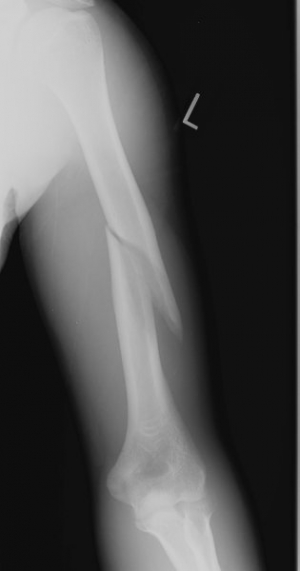 Рентгеновский снимок, на котором виден перелом плечевой кости. (кликните картинку для увеличения)