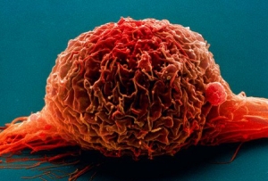 Клетка злокачественного новообразования мочевого пузыря. (кликните картинку для увеличения)