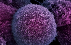 Клетка раковой опухоли предстательной железы. (кликните картинку для увеличения)