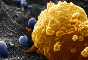 Клетка меланомы под микроскопом. (кликните картинку для увеличения)