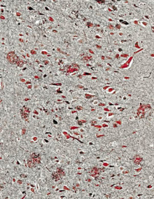 Изображение бляшек и клубков – характерных особенностей болезни Альцгеймера – под микроскопом.