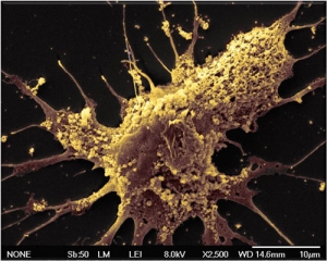 Клетка глиобластомы. (кликните картинку для увеличения)