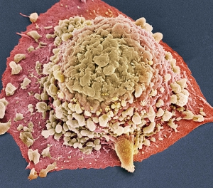 Клетка злокачественного новообразования толстого кишечника. (кликните картинку для увеличения)
